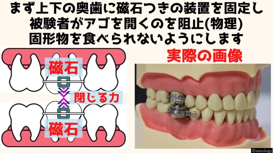 磁石で口を「物理的にロック」する減量装置が開発される