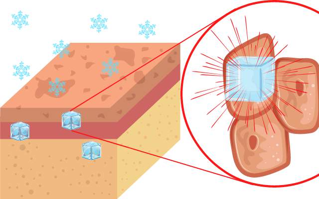 冷たいはずのドライアイスで「やけど」するのはなぜか?