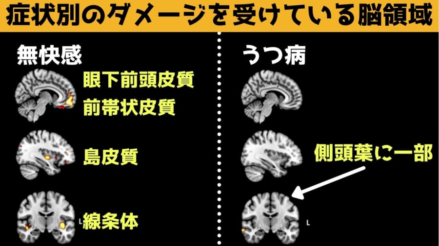 快楽の神経細胞が死滅する早期認知症が、誤って「うつ病」と診断されていたかもしれない