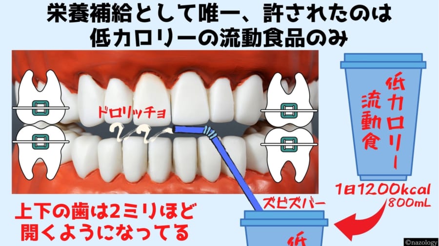 磁石で口を「物理的にロック」する減量装置が開発される