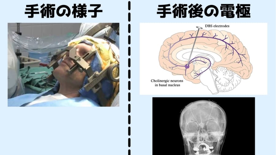 「患者が起きたまま脳に電極を刺し」強迫性障害を治療することに成功