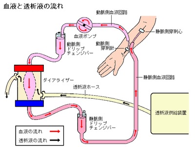 「人工腎臓」の試作に成功!透析患者の生活の質を改善させる