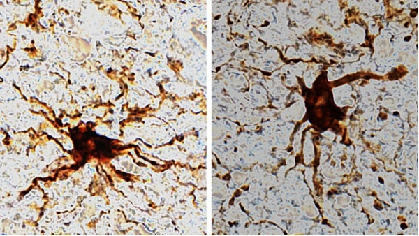 ヒトの脳内で死後も増殖する「ゾンビ細胞」を発見