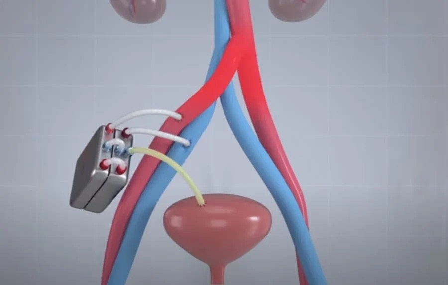 「人工腎臓」の試作に成功!透析患者の生活の質を改善させる
