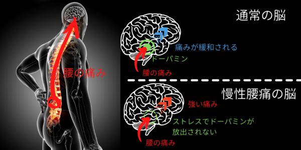 Nintendo「リングフィットアドベンチャー」が慢性腰痛症に効くと明らかに